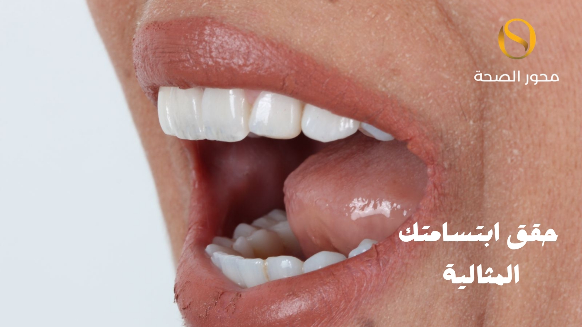 كل ما تريد معرفته عن الفينير