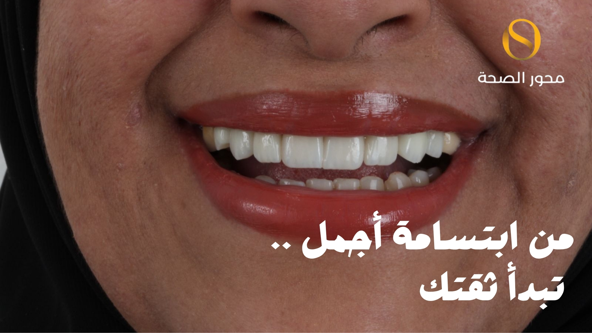 العناية بالأسنان بعد التبييض